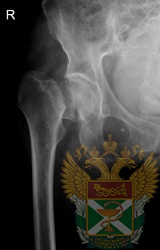 Рентген - перелом шейки бедра